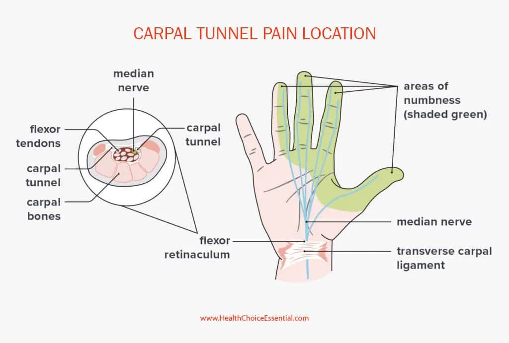 carpal tunnel pain location